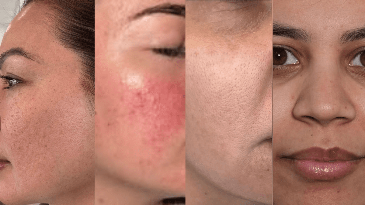 Facial Rejuvination & Korean Glass Skin before
