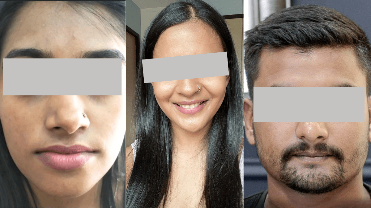 Skin Lightening & Tan Removal after